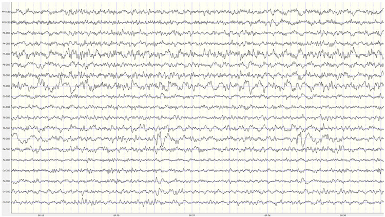 Second recording Laplacian montage isolating slow activity at F7